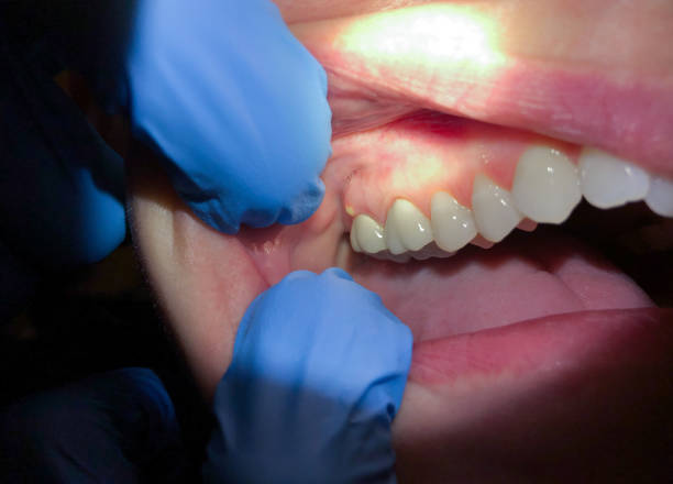 Best Cracked Tooth Emergency Dentist  in Leon, IA